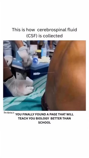 medicolife on Instagram: "Cerebrospinal Fluid (CSF) collection a vital procedure done through a lumbar puncture to analyze brain and spinal health. This clear fluid gives doctors key insights into infections, bleeding, and neurological disorders. CSF (Cerebrospinal fluid) HAT WILL collection is a medical test where a smallAN amount of the fluid surrounding the brain and spinal cord is removed for analysis. The most common method is a lumbar puncture (spinal tap), performed by inserting a needle