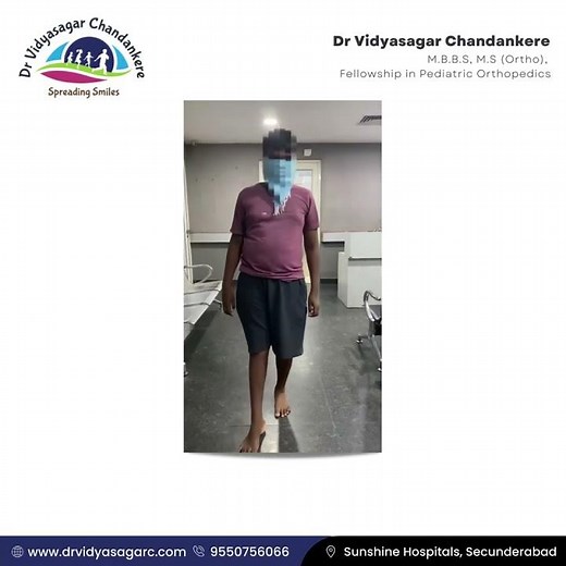 Slipped capital femoral epiphysis (SCFE) || Pre Surgery Vs Post Surgery || Dr Vidyasagar Chandankere