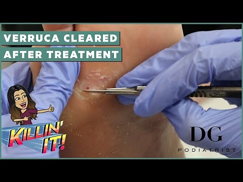Verruca removal treatment with clearal results | The Foot Scraper: DG Podiatrist