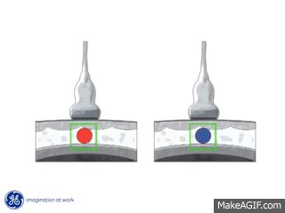 GE Healthcare LOGIQ E9 Ultrasound Elastography on Make a GIF