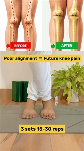 Poor Foot Alignment Can Lead to Knee Pain | Fix It Early