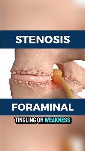 What is foraminal stenosis?
