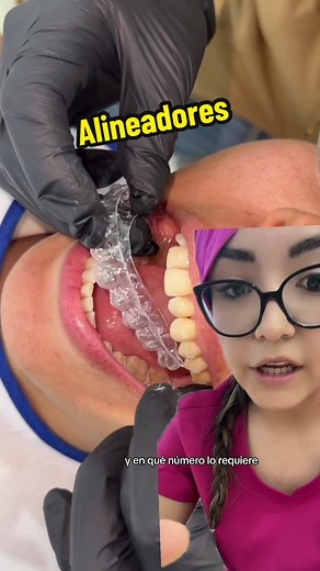 Asi como los brackets nuestros alineadores requieren de controles bimensuales para aunentar la previsibilidad de los movimientos programados💗 verificando que todo vaya como lo planificado ✨💗 #alineadores #alineadoresinvisibles #viral #alineadoresinvisiblessinbrackets #brackets #trend #foryoupage