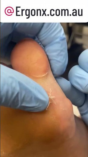 Satisfying Callus Removal at the Podiatry Clinic Big Toe Transformation #Podiatry #CallusCare