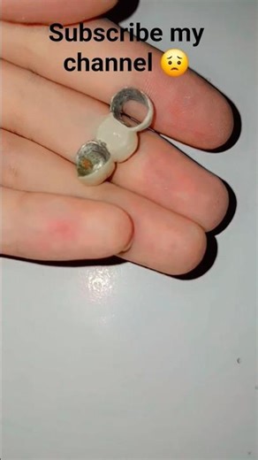 Metal Tooth Crown | Restore Your Smile with Dental Crown"#satisfying #dentist