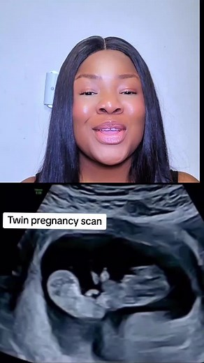 Monochorionic monoamniotic twins video #pregnancyscans #ultrasound #wongonation