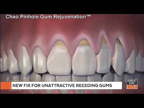Receding Gums Can Now Be Corrected Without Gum Grafting Surgery