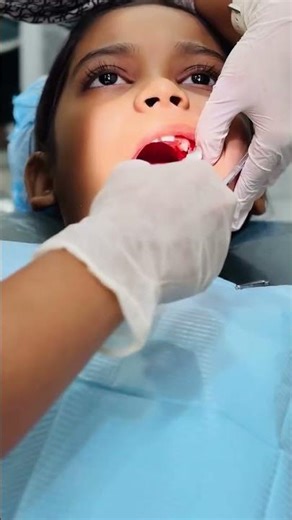 At Sai Smilecare Centre, we perform pediatric extraction followed by immediate space maintainers.🦷👶