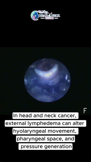 Why “Normal Anatomy” Can Still Mean an Inefficient Swallow