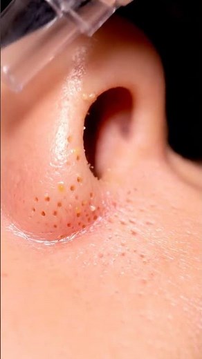 Deep Cleanse Oily Nose Pores: Vacuum Extraction ASMR 💦✨ #PoreClearing #Skincare