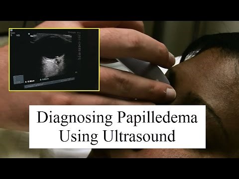 Using Ultrasound to Diagnose Papilledema