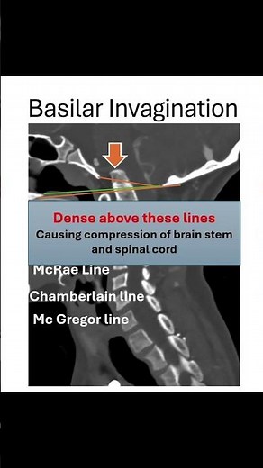 Basilar Invagination Explained in 30 Seconds#shorts #mri #neuroradiology #anatomy #radiologyshorts