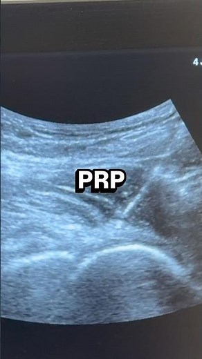 Hip injection with PRP #prp #hippain #lowbackpain #labraltear #stemcells