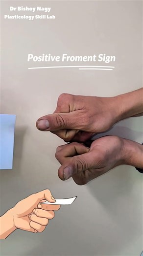 Froment's Sign Ulnar Nerve Test Adductor Policis #Plasticology #SkillLab