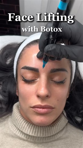Face lifting with Botox isn’t magic. It’s anatomy. Strategy. Precision. Everyone injects. Few actually lift. Watch closely 👀 This is how Botox creates structure — not a frozen face. #BotoxTechnique #FacialBalancing #AestheticEducation #LuxuryAesthetics #botoxlift | The Aesthetic Boutique