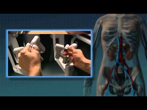 Chirurgie du rein faite avec le robot da vinci ( Intuitive ) : nephrectomie partielle
