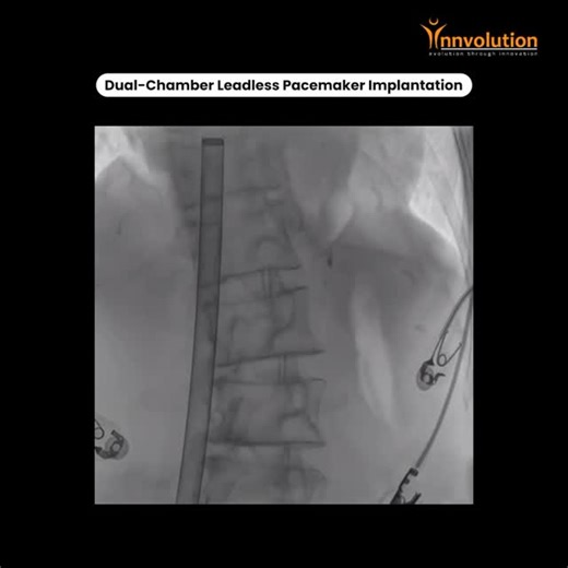 Innvolution on Instagram: "Dual-Chamber Leadless Pacemaker Implantation An 86-year-old patient with recurrent presyncope and syncopal episodes was evaluated and diagnosed with sick sinus syndrome, for which permanent dual-chamber pacing was indicated. Considering the patient’s advanced age and thin, fragile body habitus, a leadless dual-chamber pacemaker was selected as the preferred treatment strategy. The implantation was successfully performed by @dr_bharathesh_ug_cardiologist Bharathesh U.G