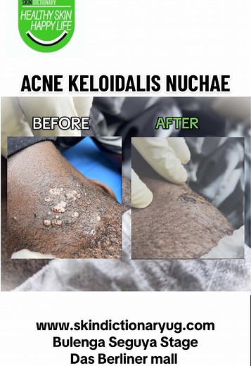Understanding Acne Keloidalis Nuchae: Causes and Treatment