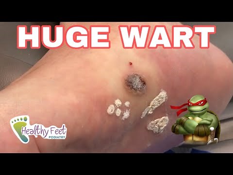 MASSIVE WART REMOVED!!!