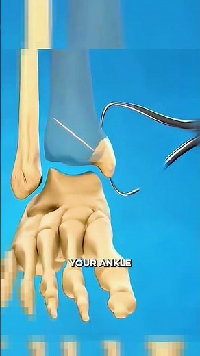 Do You Need Surgery for a Medial Malleolus Ankle Fracture?