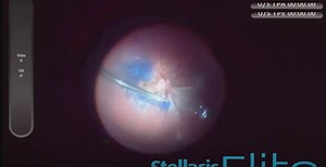Retinal Detachment in Myopic Eye With Macular Hole - Eyetube
