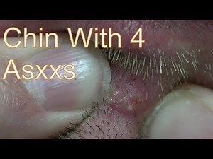 4 Headed Ball-Chinian | Life With Cystic Acne Documentary #36
