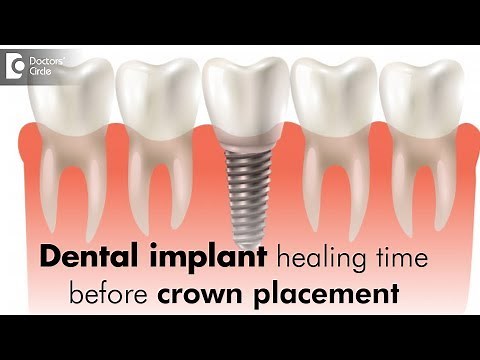 Dental implant healing time before crown placement - Dr. Sudhakara Reddy