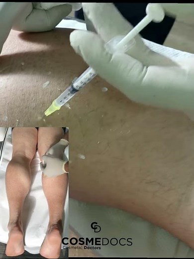 Botox Injections: Botox Calf Reduction | Before & After