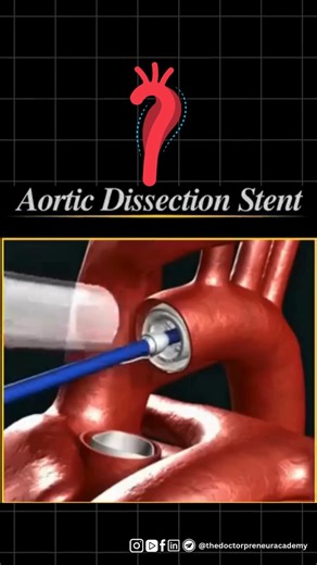 The Doctorpreneur Academy on Instagram: "Aortic Dissection Stent 👀🙌 An aortic dissection stent is a life-saving device used when the layers of the aorta start to separate. It’s placed inside the vessel to support the tear, restore proper blood flow, and lower the risk of rupture. This simple step can prevent major complications and protect long-term heart health. 🩺💉💪 #aorticdissection #hearthealth #stenttreatment #cardiachealth #medicalinnovation #heartsurgery #hastasg #healthawareness #lif
