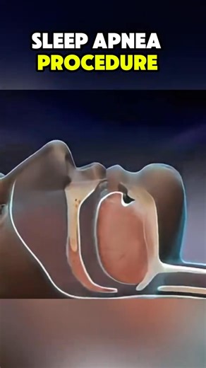 😴 Ever wondered how doctors treat sleep apnea without a CPAP mask? The Inspire implant is a small device placed under the skin that gently stimulates tongue muscles to keep the airway open at night. 🌙 ⚠️ Disclaimer: This video is for educational purposes only and is not medical advice. Always consult a qualified sleep specialist to find the right treatment for you. #doctor #BetterSleep #AirwayHealth #SleepApneaTreatment #ModernMedicine #Otolaryngology | Madical World 3D