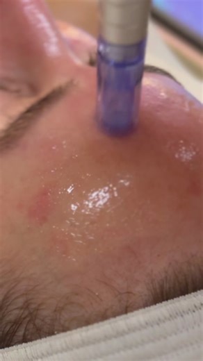 Nano infusion✨ #lasvegasfacials #facials #esthetician