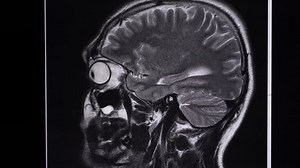 Mri Brain Scan Side View Top Stock Footage Video (100% Royalty-free) 17487706 | Shutterstock