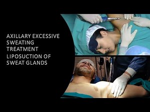 Axilla Excessive sweating treatment by Ultrasound Power assisted Liposuction (vibroliposuction)