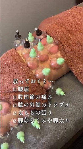 腰痛ケアはお尻と太ももから【大阪本町のRESORA鍼灸院】カッピング動画