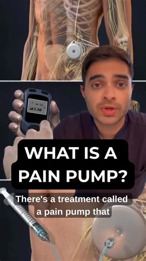 Siddartha Simha, MD on Instagram: "Most people are never told about pain pumps until they feel like they are out of options. A pain pump, also called an intrathecal drug delivery system, is not about giving up or failing treatment. It is a targeted therapy that delivers very small doses of medication directly to the spinal fluid, often with fewer systemic side effects than oral medications. For the right patient, this can mean less brain fog, lower medication burden, and better day to day functi