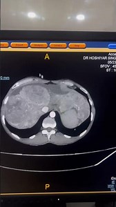 Hepatocellular carcinoma #shorts