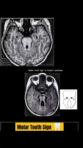 RK NURSE'S HUB on Instagram: "The molar tooth sign (MTS) in radiology refers to a characteristic appearance of the midbrain and hindbrain on an axial Magnetic Resonance Imaging (MRI) scan. It is the pathognomonic imaging feature for Joubert syndrome and related disorders (JSRD). This sign is caused by a malformation in brain development, specifically the absence of normal decussation (crossing over) of the superior cerebellar peduncles. The key features contributing to the "molar tooth" shape ar