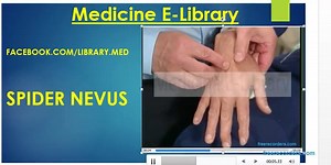 25 reactions · 15 shares | "Spider nevus" (also known as a spider...