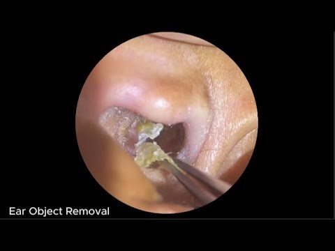 Ear Object Removal 72;;;;''';;;;#earcleaningasmr#earwaxremoval