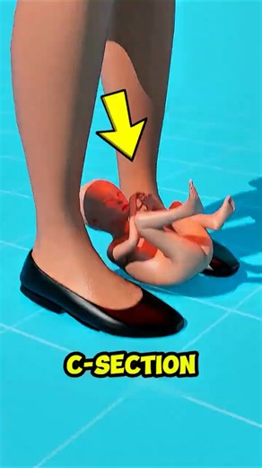 What REALLY Happens During a C-Section (Most People Have No Idea!) 😱 #shorts