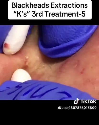 Blackheads Extractions “K’s” 3rd Treatment-5