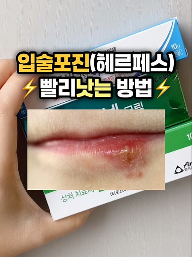 입술 포진 빨리 낫는 법 👄 아시클로버, 스테로이드, 항생제