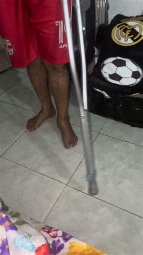 Cosas que no debes hacer sin saber que fractura tienes