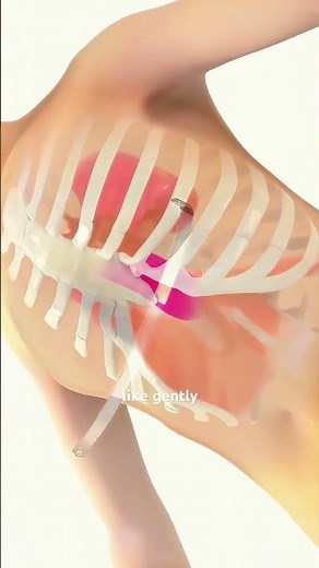 Pectins Excavatum And Nuss Procedure (3D animation) #motivation #facts #epicmusicword #3danimation