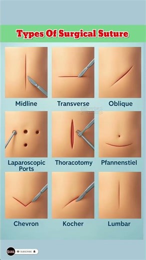 Different Types of Surgical Sutures | Complete Guide for Students