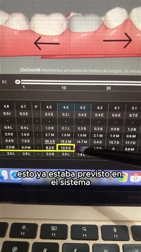 Ortodoncista, vea este punto de peligro en el ClinCheck