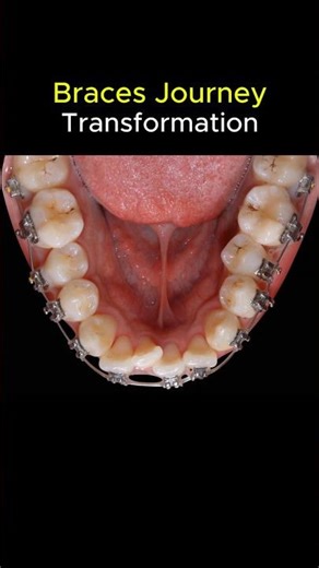 Braces journey. Crooked teeth transformation #braces #orthodontist #dentist #teeth