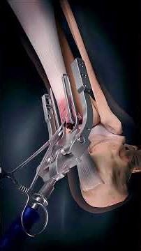 Achilles tendon repair surgery