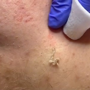 Pimple Popping Videos on Instagram: "Nice and juicy 🥰 video by @hgfacialist #acne #pimple #pimples #pimplepopper #pimplepoppervids #cyst"