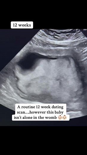 Confirming Twin Pregnancies at 12 Weeks